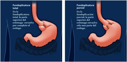 Reflujo ácido: trátelo inmediatamente para reducir las complicaciones